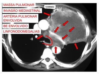 MASSA PULMONAR
INVASÃO MEDIASTINAL
ARTÉRIA PULMONAR
ENVOLVIDA
BE ENVOLVIDO
LINFONODOMEGALIAS
 