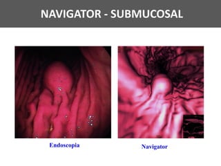 Endoscopia Navigator
NAVIGATOR - SUBMUCOSAL
 