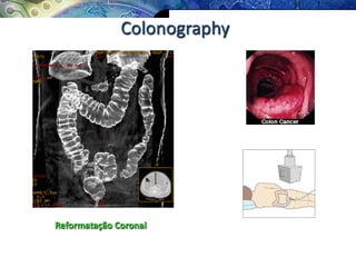Colonography
Reformatação Coronal
 