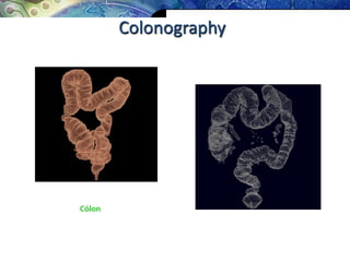 Colonography
Cólon
 