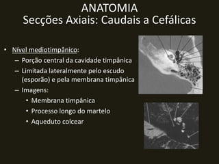 ANATOMIA
     Secções Axiais: Caudais a Cefálicas

• Nível mediotimpânico:
   – Porção central da cavidade timpânica
   – Limitada lateralmente pelo escudo
     (esporão) e pela membrana timpânica
   – Imagens:
       • Membrana timpânica
       • Processo longo do martelo
       • Aqueduto colcear
 