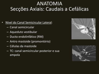 ANATOMIA
      Secções Axiais: Caudais a Cefálicas

• Nível do Canal Semicircular Lateral:
   – Canal semicircular
   – Aqueduto vestibular
   – Ducto endolinfático (RM)
   – Antro mastoide (promontório)
   – Células da mastoide
   – TC: canal semicircular posterior e sua
     ampola
 