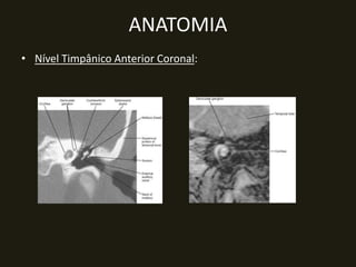ANATOMIA
• Nível Timpânico Anterior Coronal:
 
