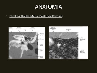 ANATOMIA
• Nível da Orelha Média Posterior Coronal:
 