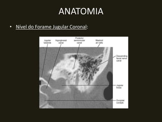 ANATOMIA
• Nível do Forame Jugular Coronal:
 