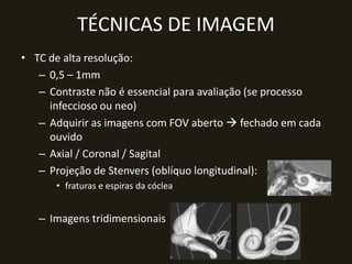 TÉCNICAS DE IMAGEM
• TC de alta resolução:
   – 0,5 – 1mm
   – Contraste não é essencial para avaliação (se processo
     infeccioso ou neo)
   – Adquirir as imagens com FOV aberto  fechado em cada
     ouvido
   – Axial / Coronal / Sagital
   – Projeção de Stenvers (oblíquo longitudinal):
      • fraturas e espiras da cóclea


   – Imagens tridimensionais
 