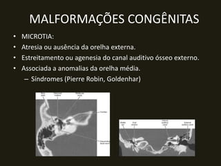 MALFORMAÇÕES CONGÊNITAS
•   MICROTIA:
•   Atresia ou ausência da orelha externa.
•   Estreitamento ou agenesia do canal auditivo ósseo externo.
•   Associada a anomalias da orelha média.
     – Síndromes (Pierre Robin, Goldenhar)
 
