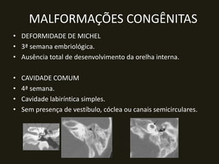 MALFORMAÇÕES CONGÊNITAS
• DEFORMIDADE DE MICHEL
• 3ª semana embriológica.
• Ausência total de desenvolvimento da orelha interna.

•   CAVIDADE COMUM
•   4ª semana.
•   Cavidade labiríntica simples.
•   Sem presença de vestíbulo, cóclea ou canais semicirculares.
 