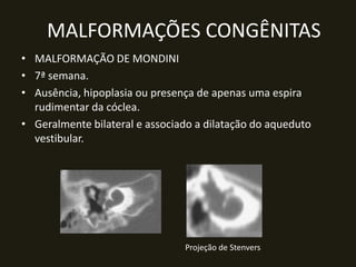 MALFORMAÇÕES CONGÊNITAS
• MALFORMAÇÃO DE MONDINI
• 7ª semana.
• Ausência, hipoplasia ou presença de apenas uma espira
  rudimentar da cóclea.
• Geralmente bilateral e associado a dilatação do aqueduto
  vestibular.




                                Projeção de Stenvers
 