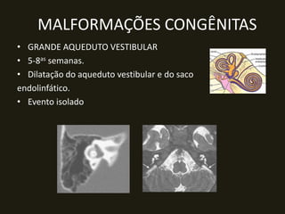 MALFORMAÇÕES CONGÊNITAS
• GRANDE AQUEDUTO VESTIBULAR
• 5-8as semanas.
• Dilatação do aqueduto vestibular e do saco
endolinfático.
• Evento isolado
 