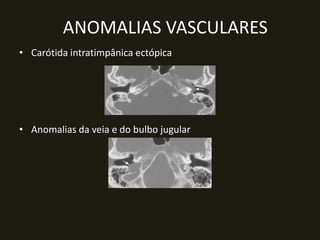 ANOMALIAS VASCULARES
• Carótida intratimpânica ectópica




• Anomalias da veia e do bulbo jugular
 