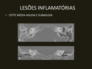 LESÕES INFLAMATÓRIAS
• OTITE MÉDIA AGUDA E SUBAGUDA
 