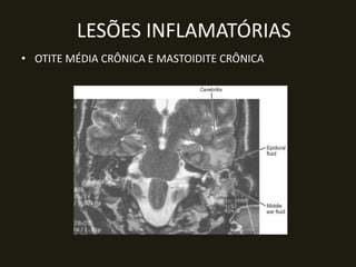 LESÕES INFLAMATÓRIAS
• OTITE MÉDIA CRÔNICA E MASTOIDITE CRÔNICA
 