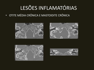 LESÕES INFLAMATÓRIAS
• OTITE MÉDIA CRÔNICA E MASTOIDITE CRÔNICA
 