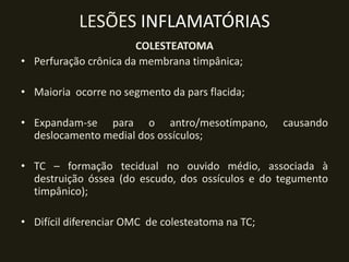 LESÕES INFLAMATÓRIAS
                       COLESTEATOMA
• Perfuração crônica da membrana timpânica;

• Maioria ocorre no segmento da pars flacida;

• Expandam-se para o antro/mesotímpano,            causando
  deslocamento medial dos ossículos;

• TC – formação tecidual no ouvido médio, associada à
  destruição óssea (do escudo, dos ossículos e do tegumento
  timpânico);

• Difícil diferenciar OMC de colesteatoma na TC;
 