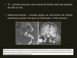 • TC – erosão óssea por uma massa de tecido mole das paredes
  do CAE ou CAI;

• Adenocarcinomas – achados iguais ao carcinomas de células
  escamosas, porém mtx para os linfonodos é mto comum;
 