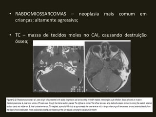 • RABDOMIOSSARCOMAS – neoplasia mais comum em
  crianças; altamente agressiva;

• TC – massa de tecidos moles no CAI, causando destruição
  óssea;
 