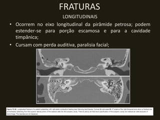 FRATURAS
                     LONGITUDINAIS
• Ocorrem no eixo longitudinal da pirâmide petrosa; podem
  estender-se para porção escamosa e para a cavidade
  timpânica;
• Cursam com perda auditiva, paralisia facial;
 