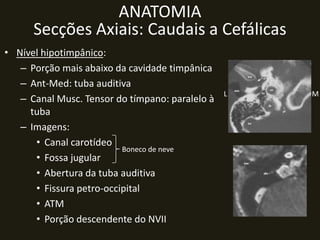 ANATOMIA
      Secções Axiais: Caudais a Cefálicas
• Nível hipotimpânico:
   – Porção mais abaixo da cavidade timpânica
   – Ant-Med: tuba auditiva
                                                 L   M
   – Canal Musc. Tensor do tímpano: paralelo à
     tuba
   – Imagens:
      • Canal carotídeo
                          Boneco de neve
      • Fossa jugular
      • Abertura da tuba auditiva
      • Fissura petro-occipital
      • ATM
      • Porção descendente do NVII
 