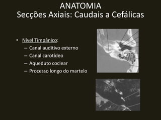 ANATOMIA
Secções Axiais: Caudais a Cefálicas

• Nível Timpânico:
   – Canal auditivo externo
   – Canal carotídeo
   – Aqueduto coclear
   – Processo longo do martelo
 