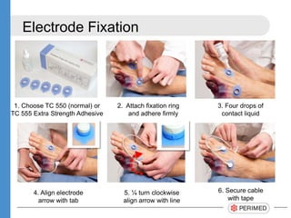 Electrode Fixation
4. Align electrode
arrow with tab
6. Secure cable
with tape
5. ¼ turn clockwise
align arrow with line
2. Attach fixation ring
and adhere firmly
3. Four drops of
contact liquid
1. Choose TC 550 (normal) or
TC 555 Extra Strength Adhesive
 