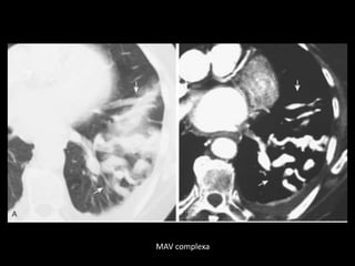 MAV complexa
 