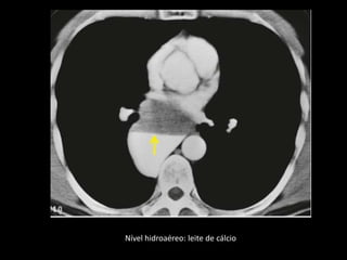 Nível hidroaéreo: leite de cálcio
 