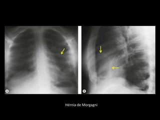 Hérnia de Morgagni
 