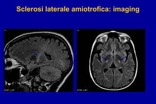 Comprehensive Overview of Amyotrophic Lateral Sclerosis (ALS ...