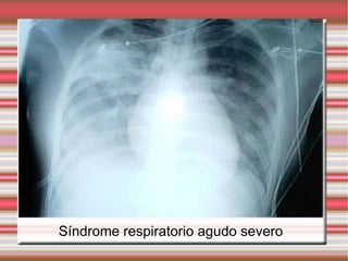 Síndrome respiratorio agudo severo 