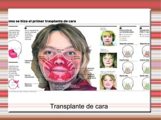 Transplante de cara 