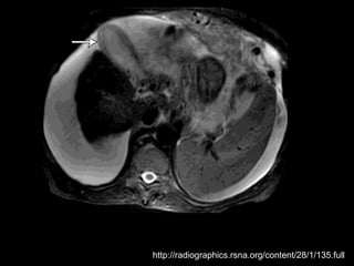 http://radiographics.rsna.org/content/28/1/135.full
 