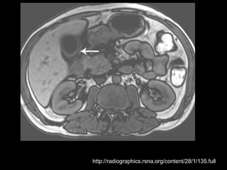 http://radiographics.rsna.org/content/28/1/135.full
 