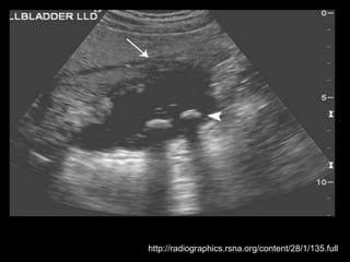http://radiographics.rsna.org/content/28/1/135.full
 