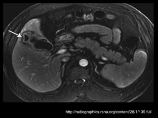 http://radiographics.rsna.org/content/28/1/135.full
 