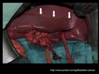 http://www.pres2.com/gallbladder-cancer/
 