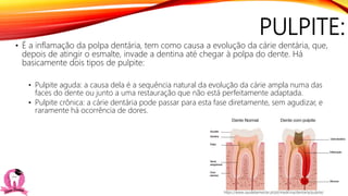 PULPITE:
• É a inflamação da polpa dentária, tem como causa a evolução da cárie dentária, que,
depois de atingir o esmalte, invade a dentina até chegar à polpa do dente. Há
basicamente dois tipos de pulpite:
• Pulpite aguda: a causa dela é a sequência natural da evolução da cárie ampla numa das
faces do dente ou junto a uma restauração que não está perfeitamente adaptada.
• Pulpite crônica: a cárie dentária pode passar para esta fase diretamente, sem agudizar, e
raramente há ocorrência de dores.
https://www.saudebemestar.pt/pt/medicina/dentaria/pulpite/
 
