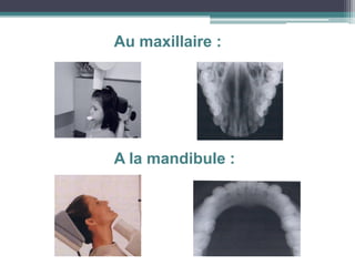 Au maxillaire :
A la mandibule :
 