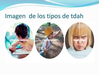 Imagen de los tipos de tdah
 