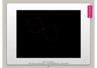 Marina Barthe 
TD1 DU Contactologie - ISO BORDEAUX - 2014/2015 
11 
K 
E 
R 
A 
T 
O 
 