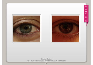 Marina Barthe 
TD1 DU Contactologie - ISO BORDEAUX - 2014/2015 
24 
B 
I 
O 
M 
E 
T 
R 
I 
E 
 