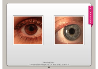Marina Barthe 
TD1 DU Contactologie - ISO BORDEAUX - 2014/2015 
25 
B 
I 
O 
M 
E 
T 
R 
I 
E 
 