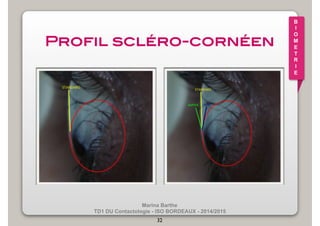 Marina Barthe 
TD1 DU Contactologie - ISO BORDEAUX - 2014/2015 
32 
B 
I 
O 
M 
E 
T 
R 
I 
E 
Profil scléro-cornéen! 
 