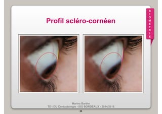 Marina Barthe 
TD1 DU Contactologie - ISO BORDEAUX - 2014/2015 
34 
B 
I 
O 
M 
E 
T 
R 
I 
E 
Profil scléro-cornéen 
 