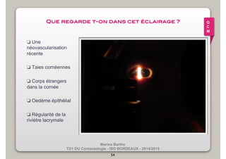 Que regarde t-on dans cet éclairage ?! 
Marina Barthe 
❏ Une 
néovascularisation 
récente 
❏ Taies cornéennes 
❏ Corps étrangers 
dans la cornée 
❏ Oedème épithélial 
TD1 DU Contactologie - ISO BORDEAUX - 2014/2015 
❏ Régularité de la 
riviètre lacrymale 
54 
Q 
C 
M 
 