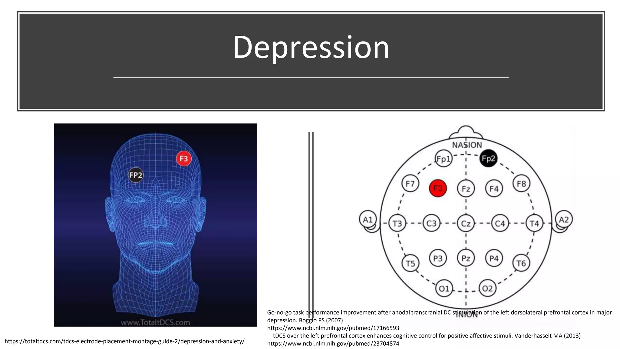 Depression
Go-no-go task performance improvement after anodal transcranial DC stimulation of the left dorsolateral prefrontal cortex in major
depression. Boggio PS (2007)
https://www.ncbi.nlm.nih.gov/pubmed/17166593
tDCS over the left prefrontal cortex enhances cognitive control for positive affective stimuli. Vanderhasselt MA (2013)
https://www.ncbi.nlm.nih.gov/pubmed/23704874https://totaltdcs.com/tdcs-electrode-placement-montage-guide-2/depression-and-anxiety/
 