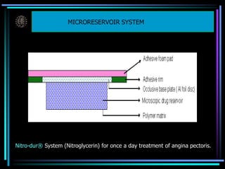 MICRORESERVOIR SYSTEM
Nitro-dur® System (Nitroglycerin) for once a day treatment of angina pectoris.
 