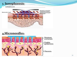 3. Sonophoresis-
4.Microneedles-
22
 