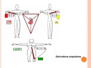Dérivations unipolaires

 