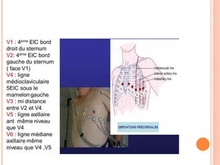 V1 : 4ème EIC bord
droit du sternum
V2: 4ème EIC bord
gauche du sternum
( face V1)
V4 : ligne
médioclaviculaire
5EIC sous le
mamelon gauche
V3 : mi distance
entre V2 et V4
V5 : ligne axillaire
ant même niveau
que V4
V6 : ligne médiane
axillaire même
niveau que V4 ,V5

 